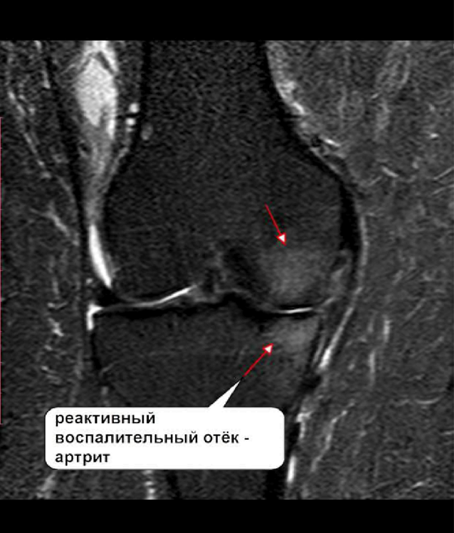 Отек костного мозга колена. Мрт исследование коленного сустава. Асептический некроз медиального мыщелка. Асептический некроз коленного сустава мрт. Асептический некроз позвонка мрт.