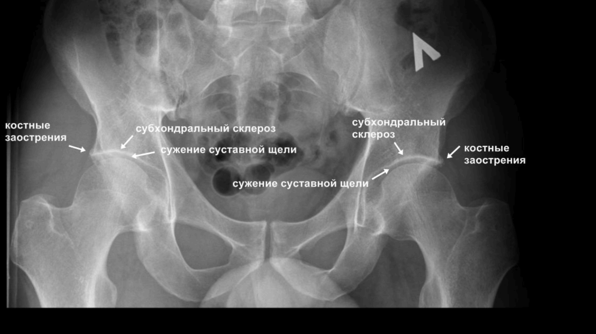 Что означает субхондральный склероз. Дисплазия вертлужной впадины тазобедренного сустава рентген. Обызвествление капсулы тазобедренного сустава рентген. Тазобедренный сустав рентген анатомия. Рентген снимок тазобедренного сустава норма.